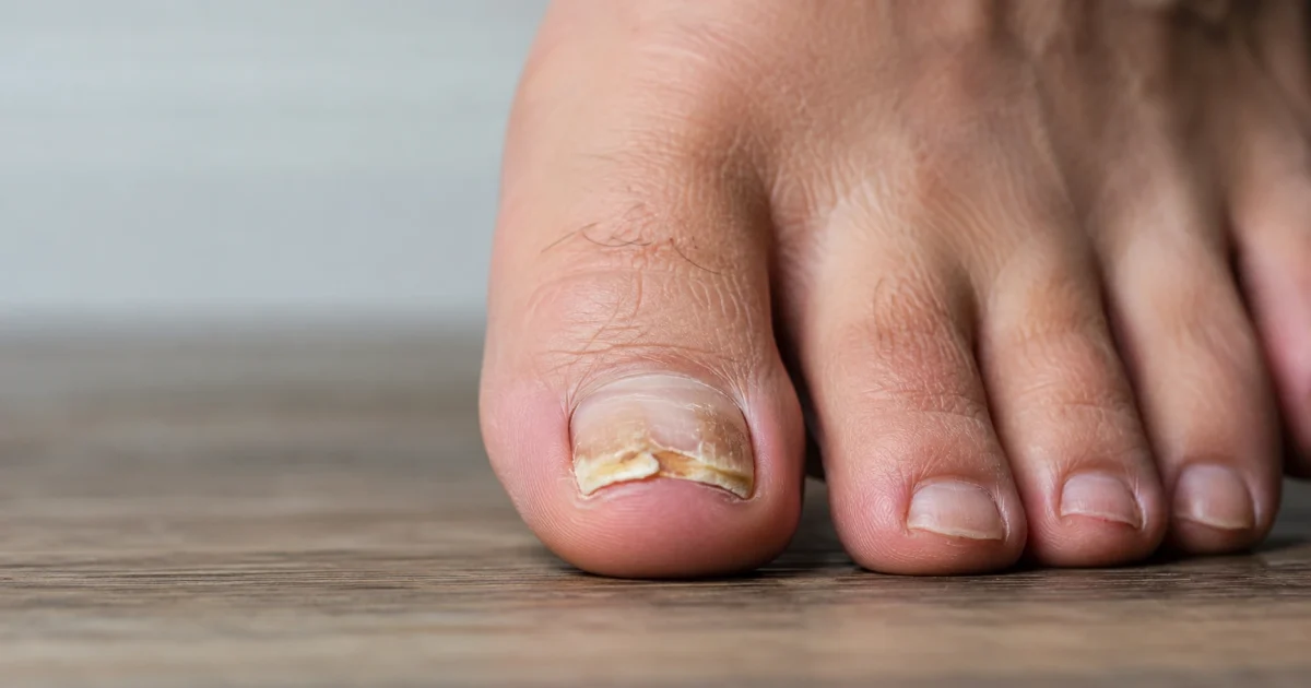 fungalnailinfection